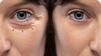 BLEFAROPLASTIA